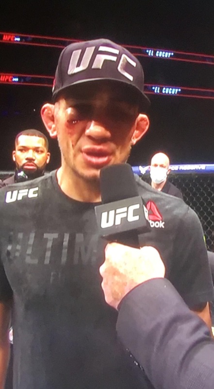 PHOTO Giant Dent Under Tony Ferguson's Eye After Losing UFC 249